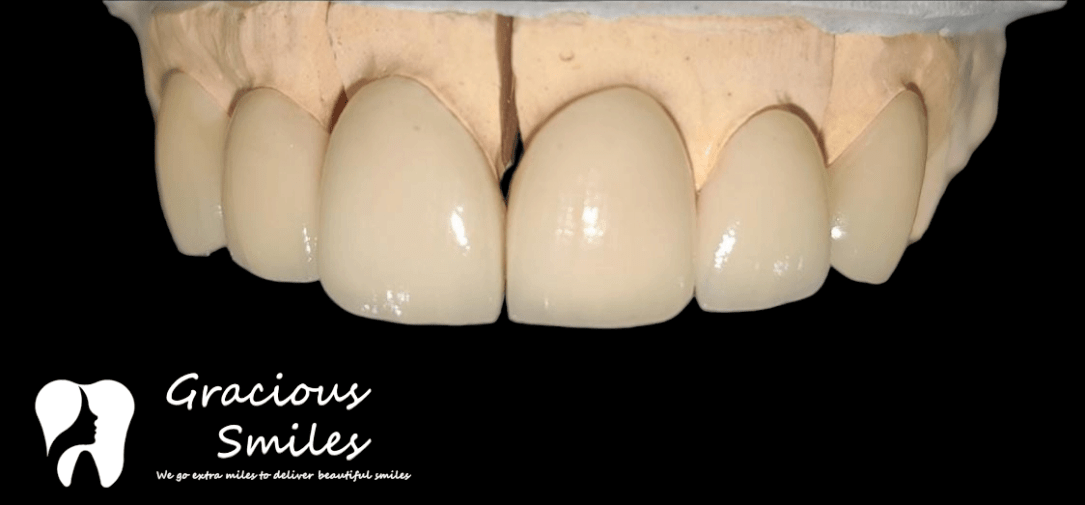Gracious Smiles: Revitalising Your Smile with&nbsp;Veneers